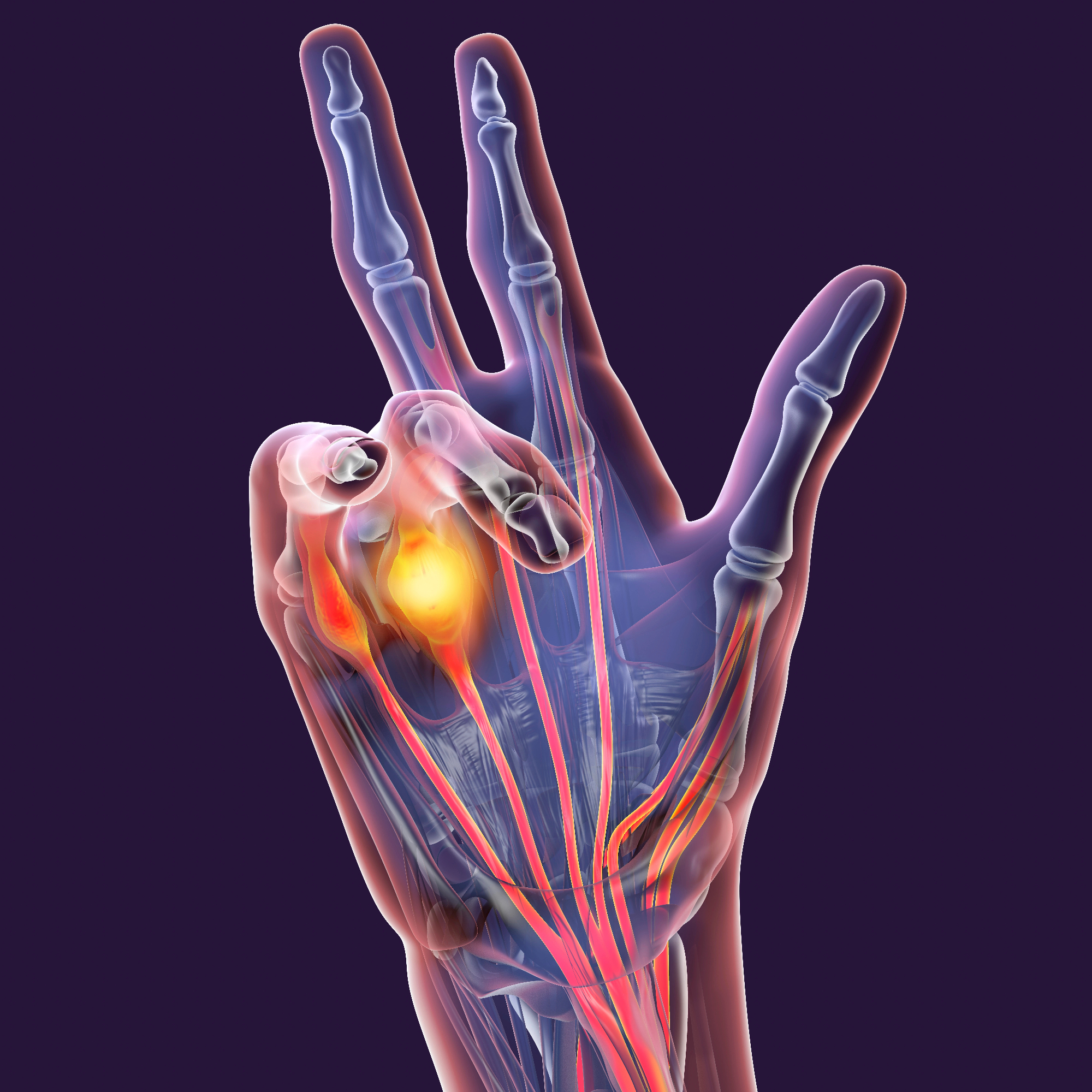 Kaj dupuytrenova kontraktura sploh je in ali je nevarna